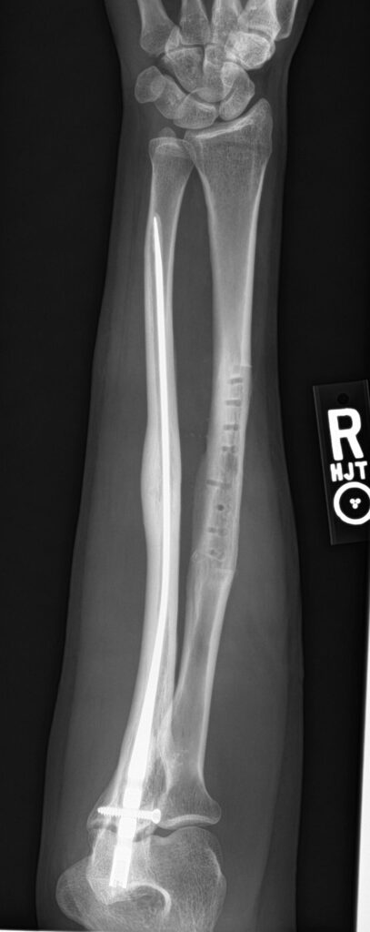 xray of right arm with "R" next to it
